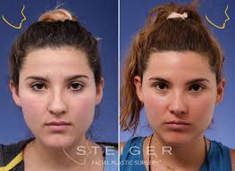 How much does it cost to get a nose job. Rhinoplasty Advanced Nose Job Specialist In Boca Raton Florida