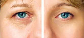 Goz Cevresi Kirisiklik Kremi Kullanimi Ve Faydalari Kirisiklik Gen Tr