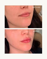 New Lips for this first timer 💋 Patch Test required Boom Online ⬇️  dawnonlaesthetics.book.app