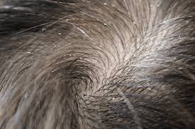 Image result for lice vs dandruff