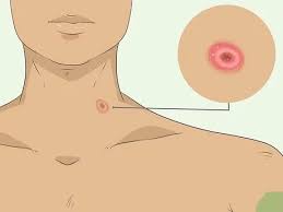 Your doctor may look at your skin to determine whether your skin changes are likely to be skin cancer. How To Check For Skin Cancer 9 Steps With Pictures Wikihow
