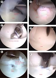 Palmer classification of tfcc abnormalities. Triangular Fibrocartilage Complex Repair Through Bone Tunnels Palmer Type 1d Sciencedirect