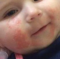 Eksim atopik adalah kondisi yang sangat sering menyerang adanya ruam kemerahan pada bagian kulit atau tubuh bayi. Ruam Kulit Bayi Jenis Penyebab Dan Cara Mengatasinya Theasianparent Indonesia