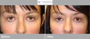 All eye lift surgery photos are of patients of prasad cosmetic surgery, with offices in garden city, long island, ny and midtown manhattan, near grand central station. Before And After Canthoplasty Photos Mehryar Ray Taban Md