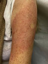 The moderna covid‑19 vaccine (pinn: Covid Arm A Reaction To The Moderna Vaccine Jaad Case Reports