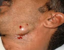 First things first, exfoliate the area to remove the top layer of skin that may. How To Cure Hair Rustling Causes Of Rustling Of Hair After Epilation Shugaring Shaving Regular Use Of Scrabets