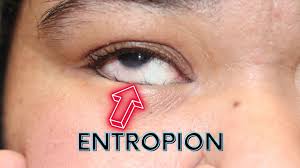 Image result for Entropion
