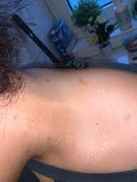 Roschenflechte Hilfe Haut Juckreiz Dermatologie