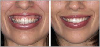 A gum lift involves removing a portion of the gum tissue. Fix Your Gummy Smile It S Easier And Less Expensive Than You May Think Revival By Stacy