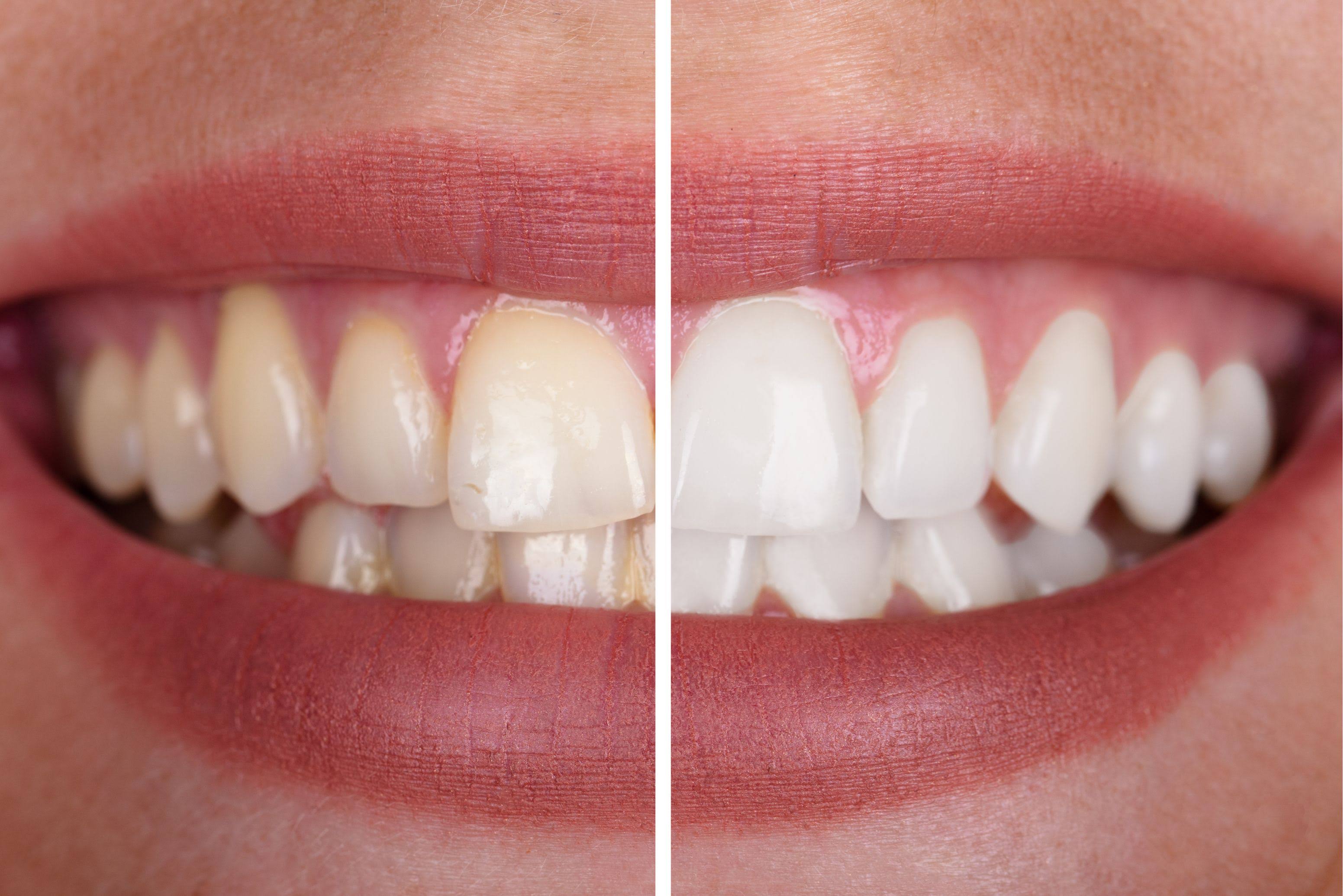 Teeth Whitening product image