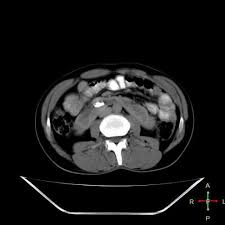 Orseshoe Kidneys Are The Most Common Type Of Renal Fusion Anomaly See Developmental Renal Anomalies They Render Radiology Imaging Renal Calculi Renal Stones