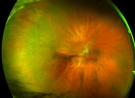 Uveitis is inflammation of the uveal tract which can be caused by autoimmune disorders such as rheumatoid arthritis or infection which can be idiopathic. Retinal Holes And Tears Recognizing Pathology Optos