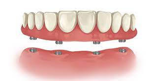 How much are dentures on nhs? Permanent Dentures Cost Frisco Tx How Much Are Fixed Dentures With Implants 2021 Same Day Highland Oak Dental
