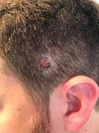 skin cancer is a common form of cancer, and it&#x27;s usually caused by prolonged sun damage. Nodular Non Pigmented Lesions On The Scalp Springerlink