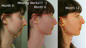 Mewing for beginners (correct tongue posture)how to mew? What Is Mewing And Does It Work