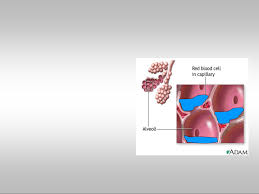 Image result for Transfusion Associated Circulatory Overload