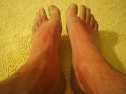 Coloca un vendaje limpio y esparadrapo, sin presionar en exceso. Ampollas En Los Pies Tratamiento Y Prevencion Blog Fiatc