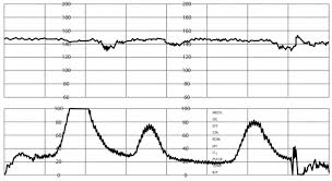 Image result for Late Deceleration