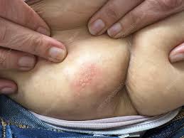 Image result for genital herpes
