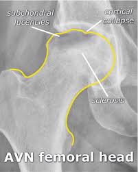Startradiology Avascular Necrosis Hip Radiology Imaging Radiology Humor