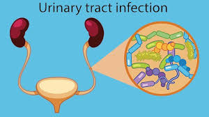 E Coli In The Urinary Tract Causes More Than 85 Percent Of All Urinary Tract Infections Or Utis The Bac In 2020 Urinary Sepsis Urinary Tract Infection Urinary Tract