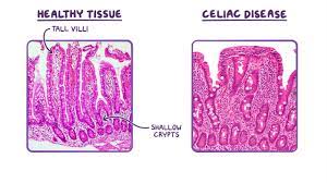 Celiac Disease Osmosis
