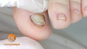 Image result for Yellow nail syndrome feet