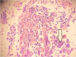 Epigastric Pain Associated With Herpes Esophagitis Case Report Bmc Infectious Diseases Full Text