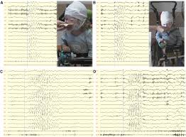 If your iphone, ipad, or ipod touch doesn't appear in the list of devices, find my was not turned on. Chewing Induced Reflex Seizures Eating Epilepsy And Eye Closure Sensitivity As A Common Feature In Pediatric Patients With Syngap1 Mutations Review Of Literature And Report Of 8 Cases Seizure European