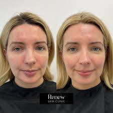 Renew Skin Clinic added a new photo —...