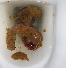 Image result for Blood in stool
