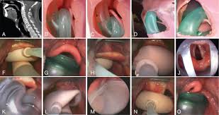 Image result for Extraglottic Device