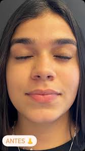 O Endolit é um laser de última geração utilizado no tratamento facial,  promovendo rejuvenescimento e melhoria na qualidade da pele. Através de  tecnologia avançada, ele estimula a produção de colágeno, reduz rugas,