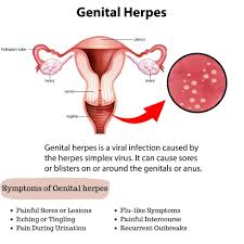 Image result for genital herpes