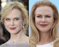 Nicole Kidman Plastic Surgery