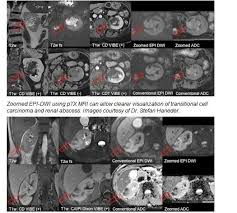 Multitransmit For Body Mri Is It Worth It At Higher Field Strengths The Hope Is For New Technology To Lead To More Cli Mri This Or That Questions Radiology