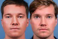 Dr Cochran in Dallas, Texas 75231 » Rhinoplasty: Cost, Pics, Reviews, Q&A