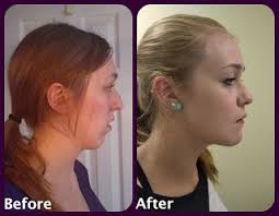 Stacy S Jaw Surgery Journey Jaw Surgery Mandibular Advancement Surgery Surgery