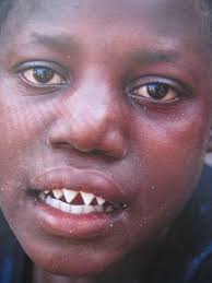 The Sharpened Teeth Of A Dogon Tribe Male Of Mali In West Africa Dogon Individuals Often Tattoo Lines Across Their Abdomens And Sharpen Their Teeth To Ma Dentes