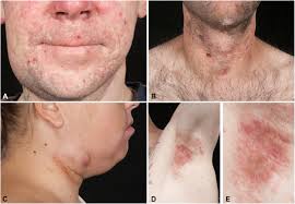Skin Manifestations in Adults With Chronic Granulomatous Disease in the  United Kingdom