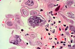 Differential diagnosis between herpes simplex virus (hsv) esophagitis and cytomegalovirus (cmv) esop. My Notes For Usmle Usmlepathslides Herpes Simplex Esophagitis In A