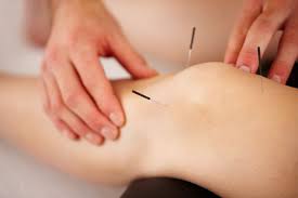Pin On Acupuncture 4 Pain