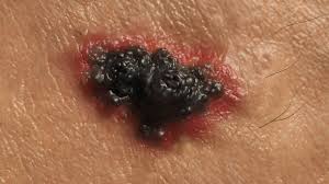 The first monday in may kicks off skin cancer awareness month, and so &quot;cbs this morning&quot; Skin Cancer Half Of People Surviving Advanced Melanoma Bbc News