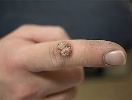 Acesta este aplicat pe piele sub formă de spray. Tratamentul Verucilor Negilor Dr Mihai Lupu