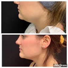 TOP 10 BEST Eyelid Surgery in Indianapolis, IN