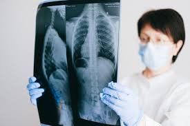 How To Qualify For Ssdi After 50 With Degenerative Disc Disease