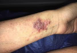 Image result for dermatitis contacta allergica
