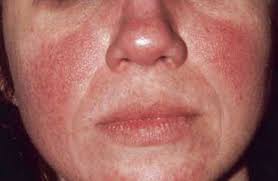 Eritema multiforme yada diğer adı ile eritem polimorf, çoğunlukla çocukları ve genç yetişkinleri etkileyen; Rozacee Cauze Simptome Tratament Poze