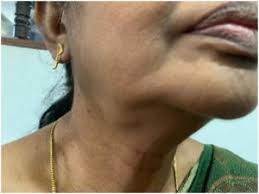 Image result for Sialolithiasis