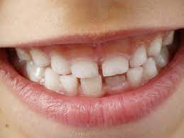 La Perdida Prematura De Los Dientes De Leche Clinica Martinez Bru
